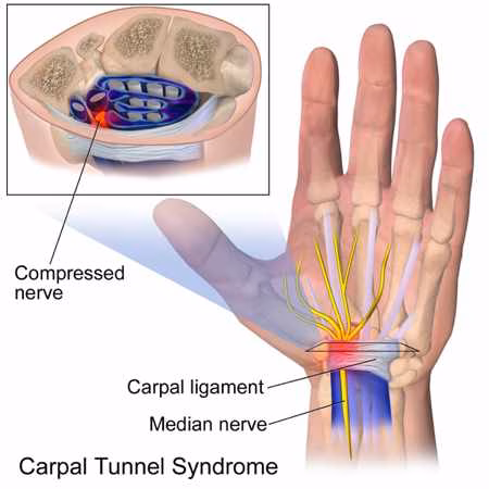 Sentencia del Tribunal Supremo sobre la consideración de enfermedad profesional del Sindrome del Túnel Carpiano en limpiadoras